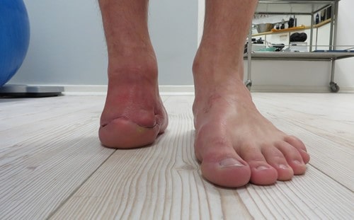 ویژگی های پنجه پروتزی پا برای سطوح مختلف قطع عضو پا