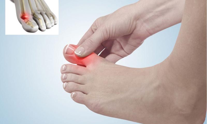 بهترین درمان درد زیر پنجه پا یا متاتارسالژیا